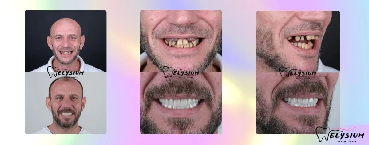 All on 4 dental implants Antalya Turkey All on 4 dental implants Antalya Turkey
